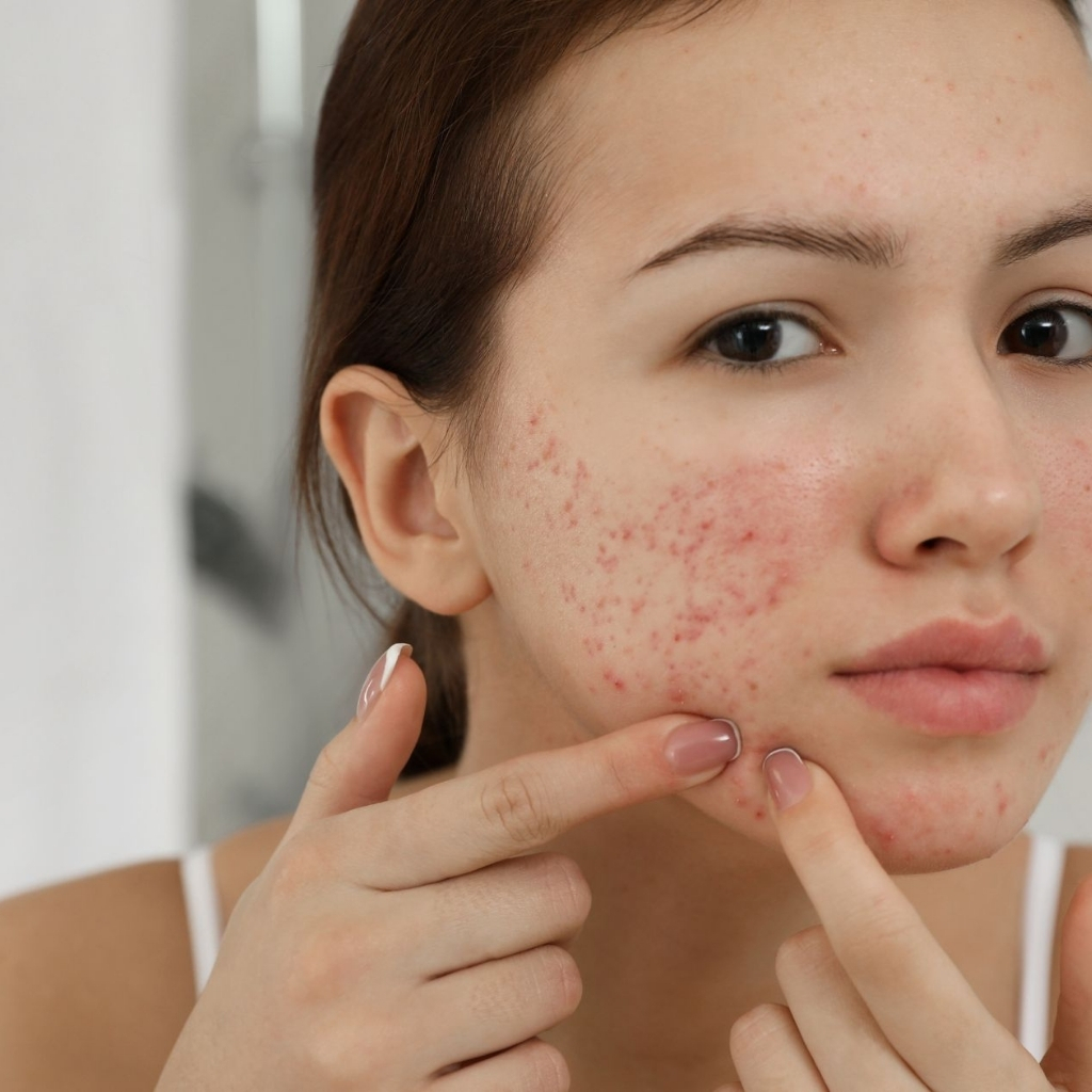 Woman with active acne and pimples looking for effective acne treatment